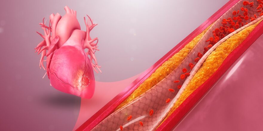 1600px-Coronary_Artery_Disease